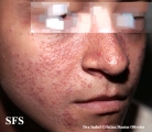sarcoidosis