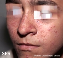 sarcoidosis