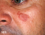 sarcoidosis