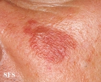 sarcoidosis