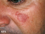 sarcoidosis