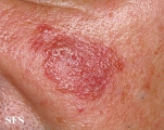 sarcoidosis