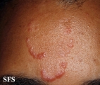 sarcoidosis