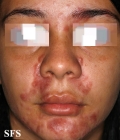 sarcoidosis