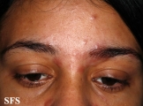 sarcoidosis