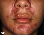 sarcoidosis