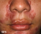 sarcoidosis