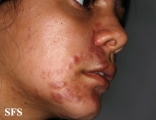 sarcoidosis