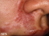 sarcoidosis