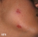 sarcoidosis