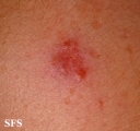 sarcoidosis