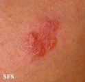 sarcoidosis