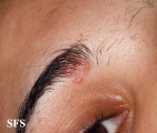 sarcoidosis