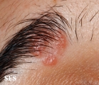 sarcoidosis