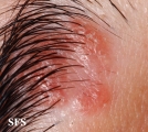 sarcoidosis
