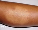 eczematid
