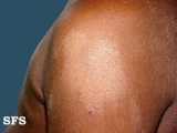 eczematid