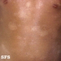 eczematid