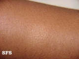 eczematid