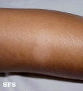 eczematid