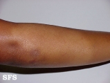 eczematid