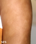 eczematid