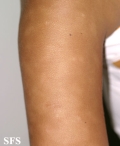 eczematid