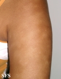eczematid