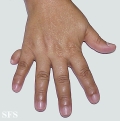 rudimentary polydactyly