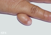 rudimentary polydactyly