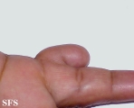 rudimentary polydactyly