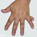 rudimentary polydactyly