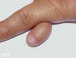 rudimentary polydactyly