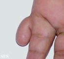 rudimentary polydactyly