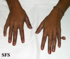 rudimentary polydactyly