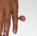 rudimentary polydactyly