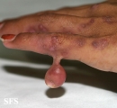 rudimentary polydactyly