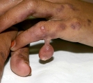 rudimentary polydactyly