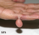 rudimentary polydactyly