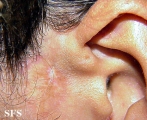 congenital auricular fistula