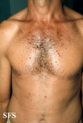 histiocytoma-generalized eruptive histiocytoma