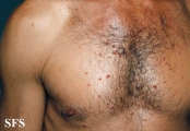 histiocytoma-generalized eruptive histiocytoma