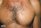 histiocytoma-generalized eruptive histiocytoma
