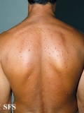 histiocytoma-generalized eruptive histiocytoma