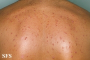 histiocytoma-generalized eruptive histiocytoma