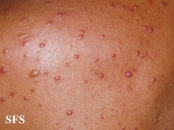 histiocytoma-generalized eruptive histiocytoma
