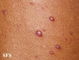 histiocytoma-generalized eruptive histiocytoma