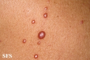 histiocytoma-generalized eruptive histiocytoma