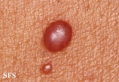 histiocytoma-generalized eruptive histiocytoma