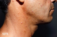 histiocytoma-generalized eruptive histiocytoma